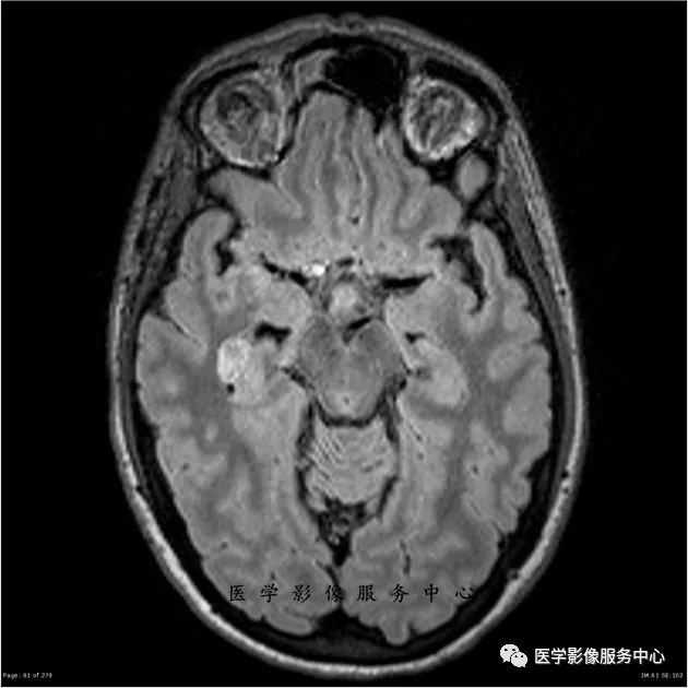 【病例】能在这个头颅CT上发现病变的都是高手—胚胎发育不良性神经上皮瘤1例 【病例】能在这个头颅CT上发现病变的都是高手—胚胎发育不良性神经上皮瘤1例