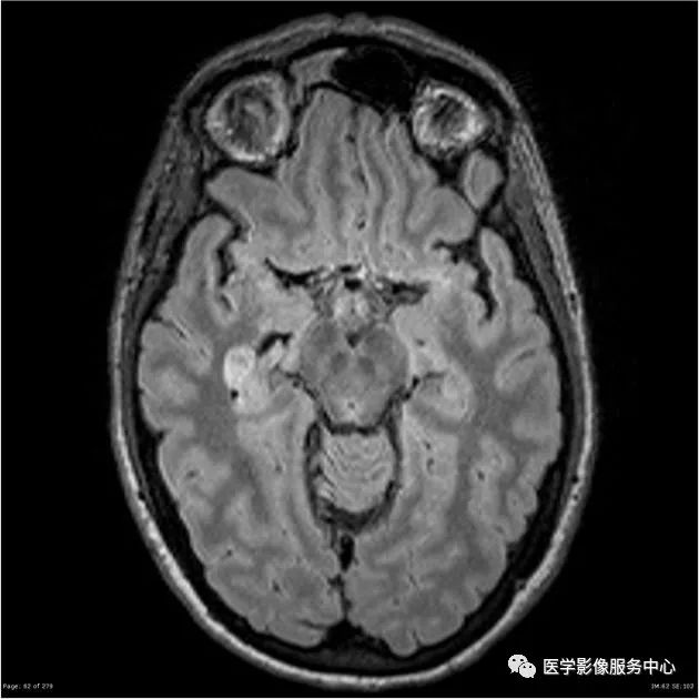 【病例】能在这个头颅CT上发现病变的都是高手—胚胎发育不良性神经上皮瘤1例 【病例】能在这个头颅CT上发现病变的都是高手—胚胎发育不良性神经上皮瘤1例