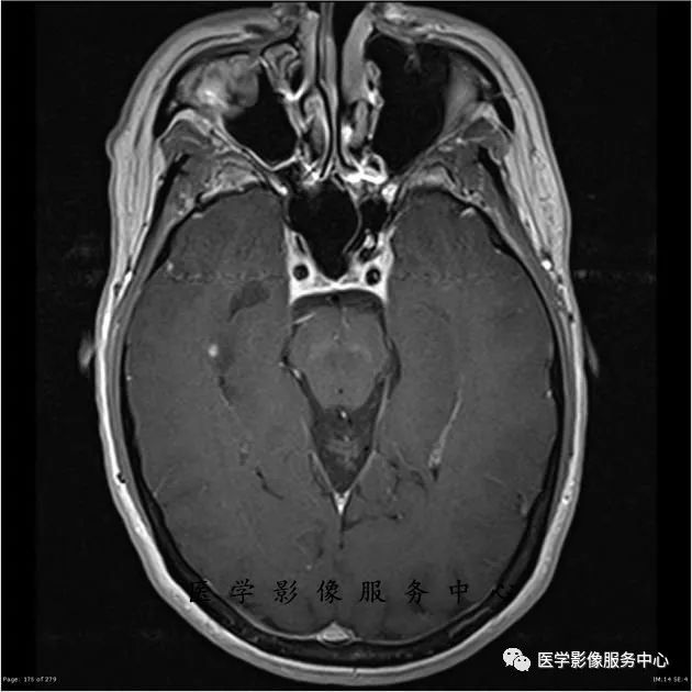 【病例】能在这个头颅CT上发现病变的都是高手—胚胎发育不良性神经上皮瘤1例 【病例】能在这个头颅CT上发现病变的都是高手—胚胎发育不良性神经上皮瘤1例