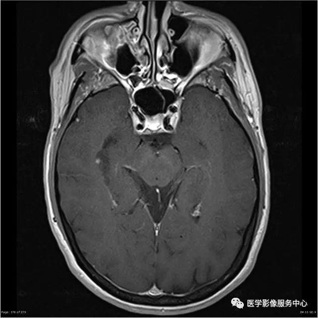【病例】能在这个头颅CT上发现病变的都是高手—胚胎发育不良性神经上皮瘤1例 【病例】能在这个头颅CT上发现病变的都是高手—胚胎发育不良性神经上皮瘤1例