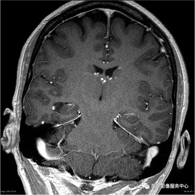【病例】能在这个头颅CT上发现病变的都是高手—胚胎发育不良性神经上皮瘤1例 【病例】能在这个头颅CT上发现病变的都是高手—胚胎发育不良性神经上皮瘤1例