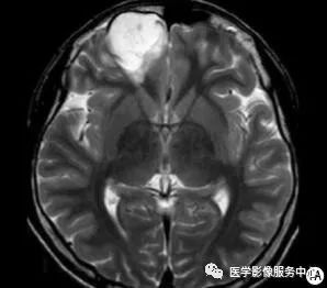 【病例】能在这个头颅CT上发现病变的都是高手—胚胎发育不良性神经上皮瘤1例 【病例】能在这个头颅CT上发现病变的都是高手—胚胎发育不良性神经上皮瘤1例