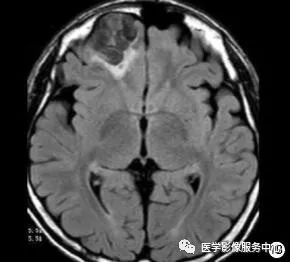 【病例】能在这个头颅CT上发现病变的都是高手—胚胎发育不良性神经上皮瘤1例 【病例】能在这个头颅CT上发现病变的都是高手—胚胎发育不良性神经上皮瘤1例