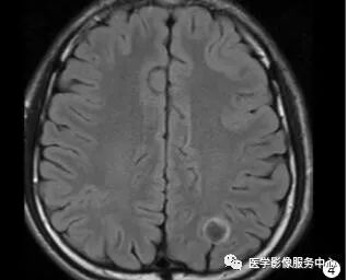 【病例】能在这个头颅CT上发现病变的都是高手—胚胎发育不良性神经上皮瘤1例 【病例】能在这个头颅CT上发现病变的都是高手—胚胎发育不良性神经上皮瘤1例