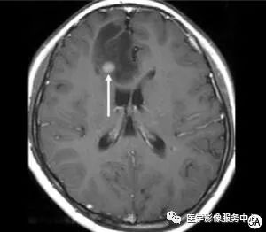【病例】能在这个头颅CT上发现病变的都是高手—胚胎发育不良性神经上皮瘤1例 【病例】能在这个头颅CT上发现病变的都是高手—胚胎发育不良性神经上皮瘤1例