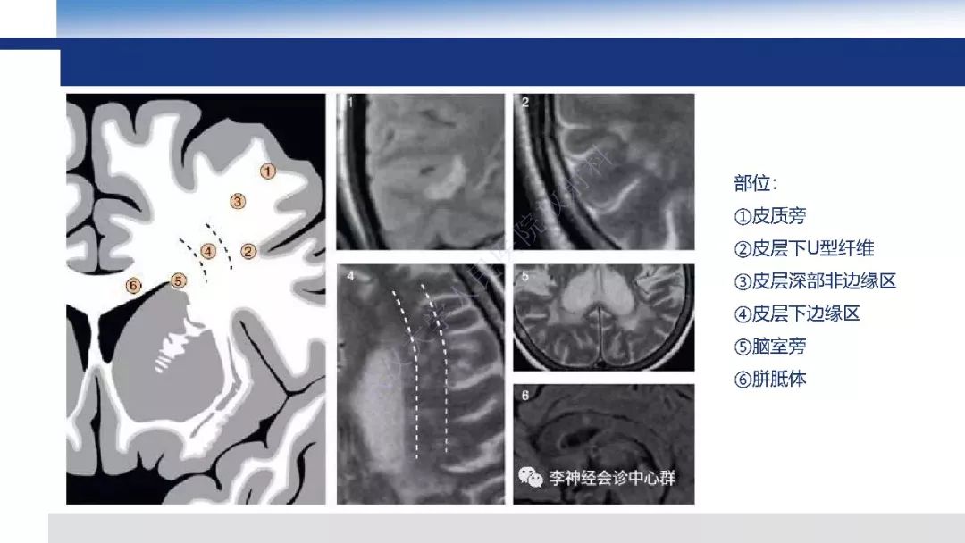 【PPT】脑白质病变影像与病理