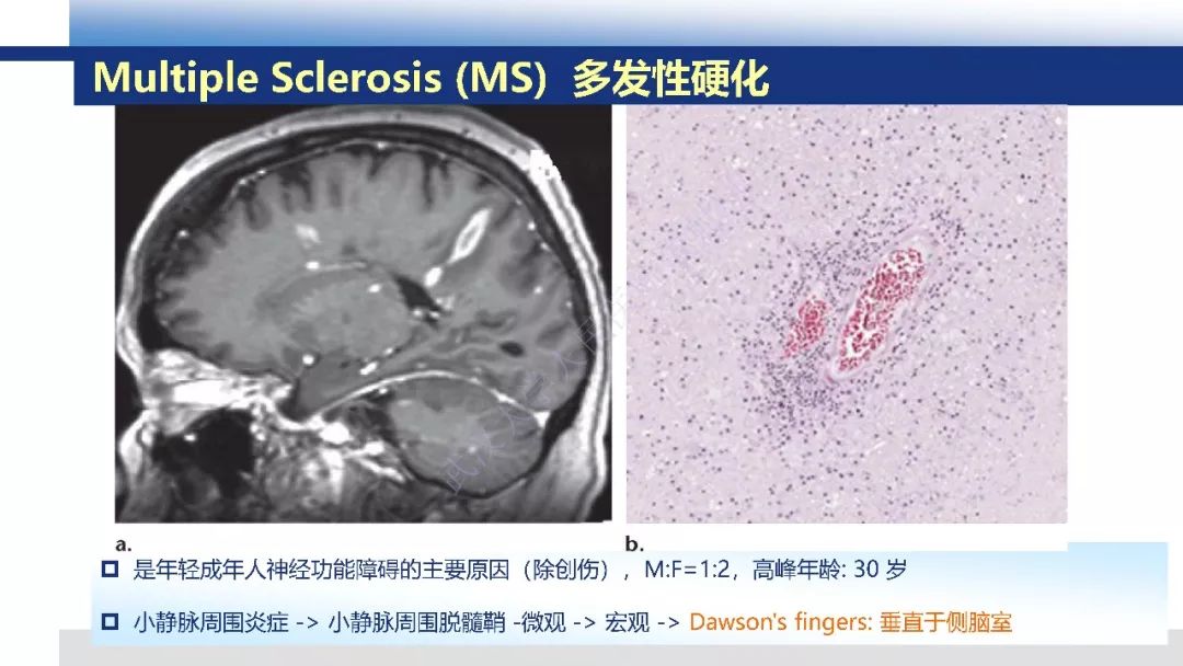 【PPT】脑白质病变影像与病理