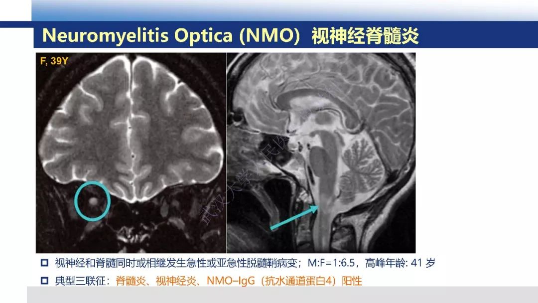 【PPT】脑白质病变影像与病理
