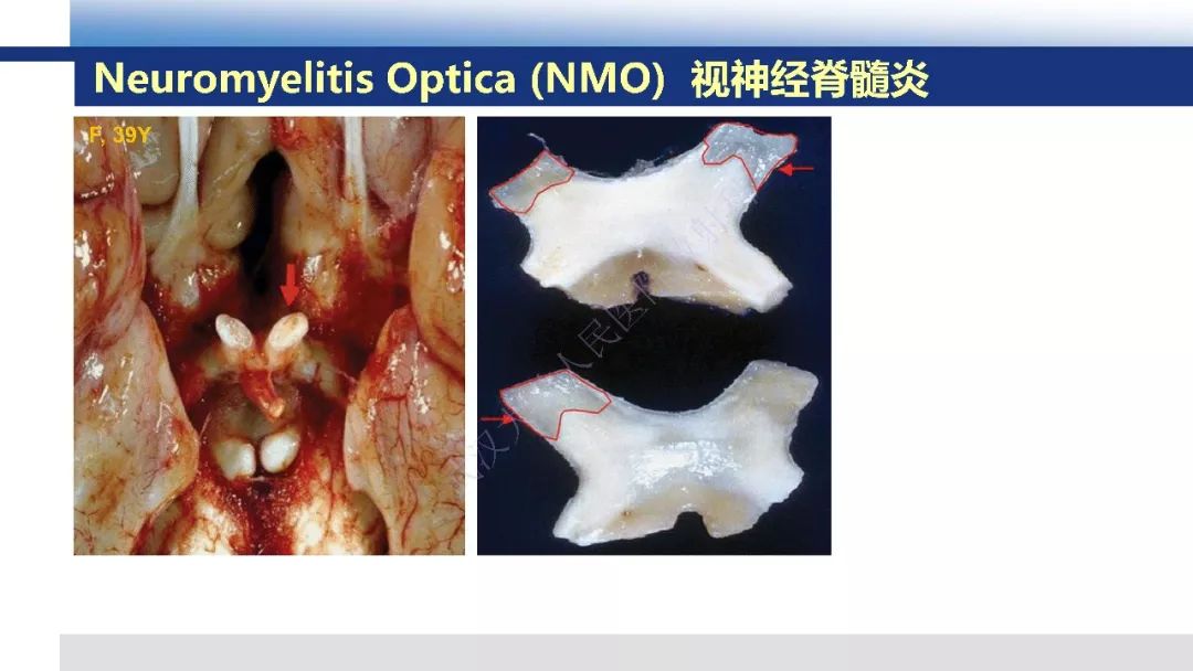 【PPT】脑白质病变影像与病理