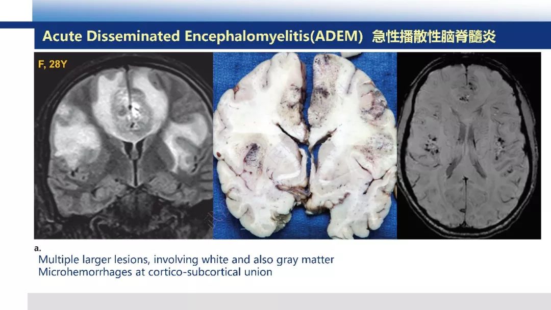 【PPT】脑白质病变影像与病理