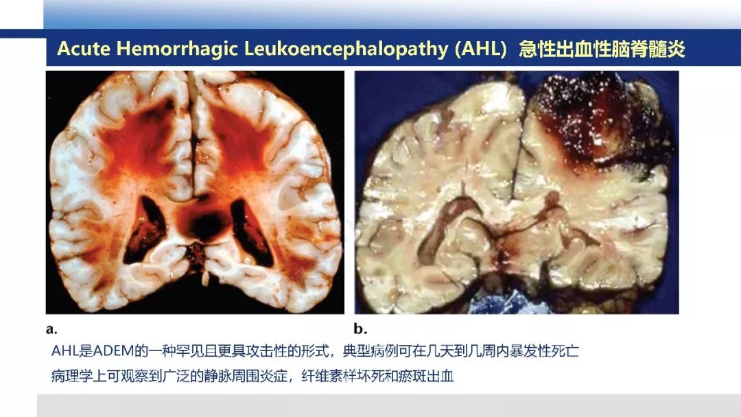 【PPT】脑白质病变影像与病理
