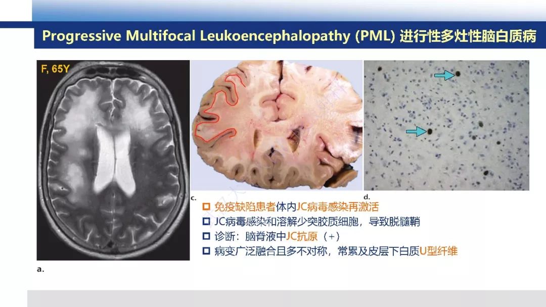 【PPT】脑白质病变影像与病理