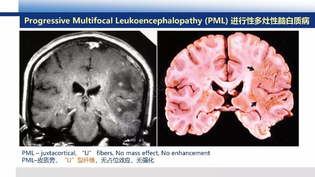 【PPT】脑白质病变影像与病理
