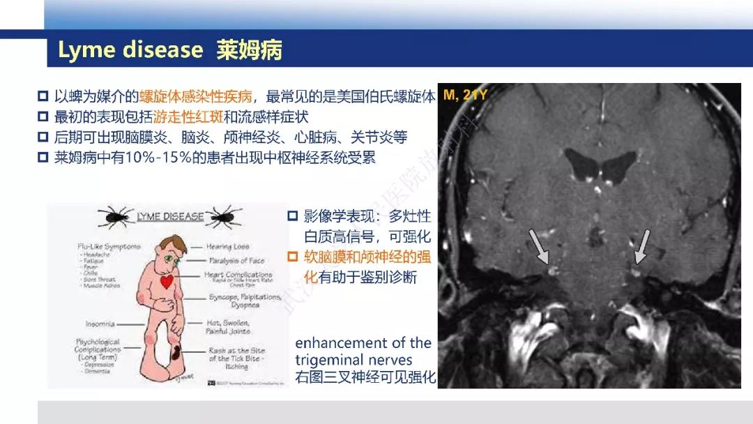 【PPT】脑白质病变影像与病理