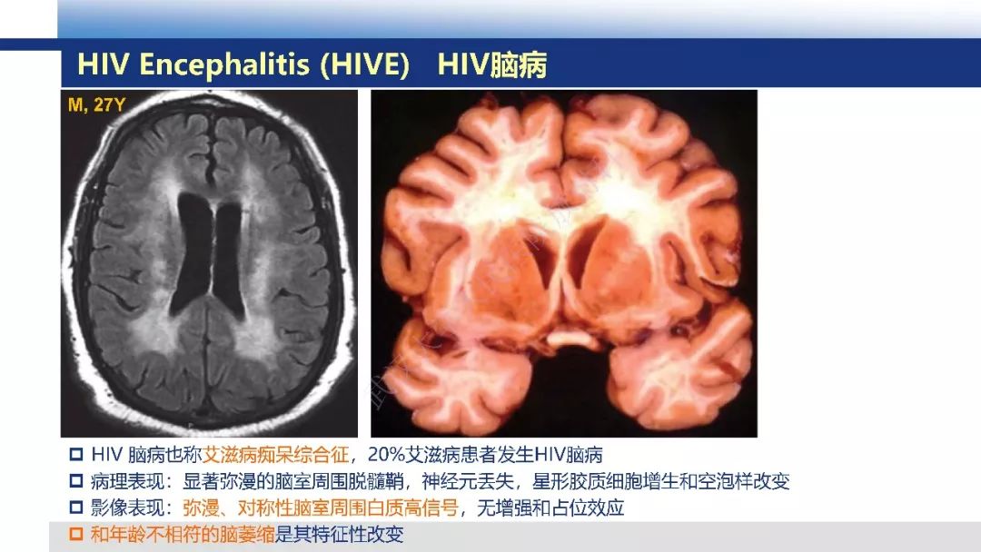 【PPT】脑白质病变影像与病理