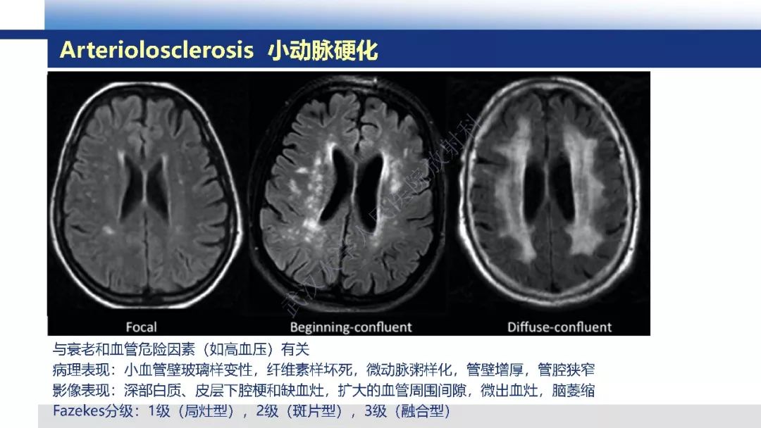 【PPT】脑白质病变影像与病理