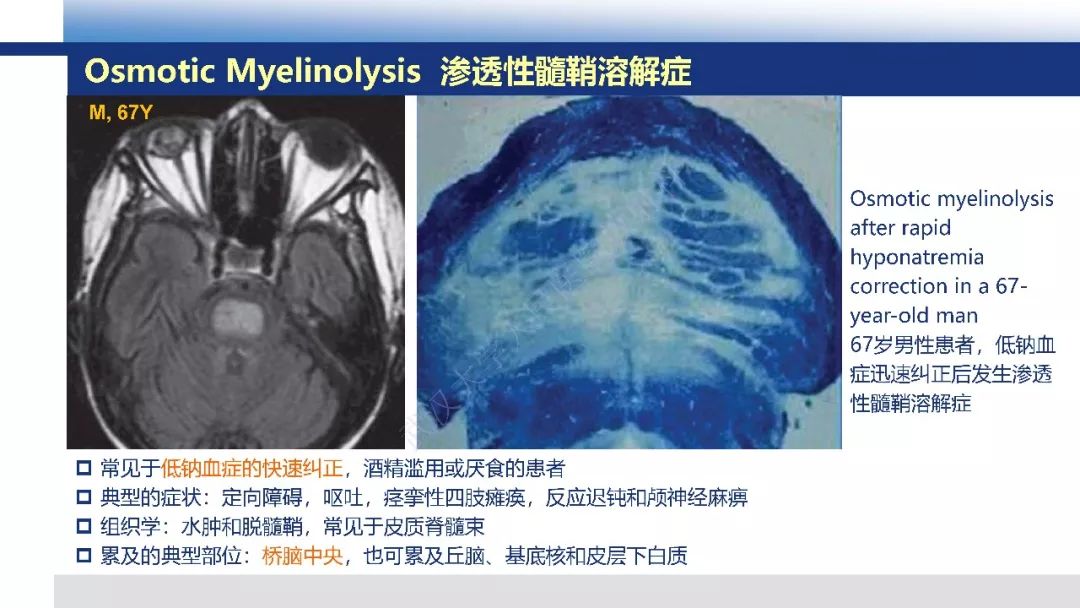 【PPT】脑白质病变影像与病理