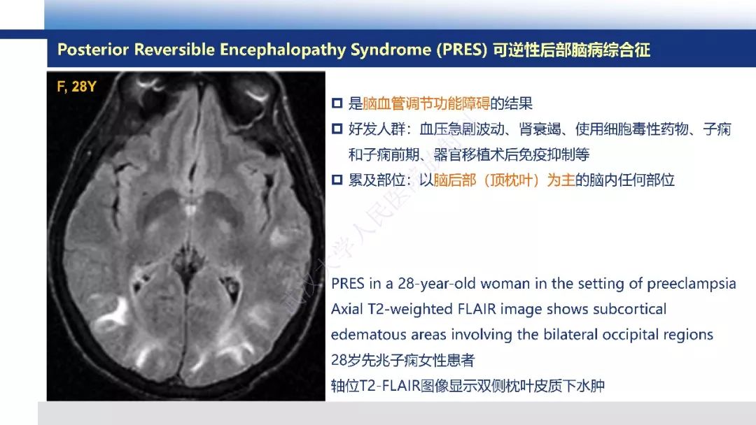 【PPT】脑白质病变影像与病理