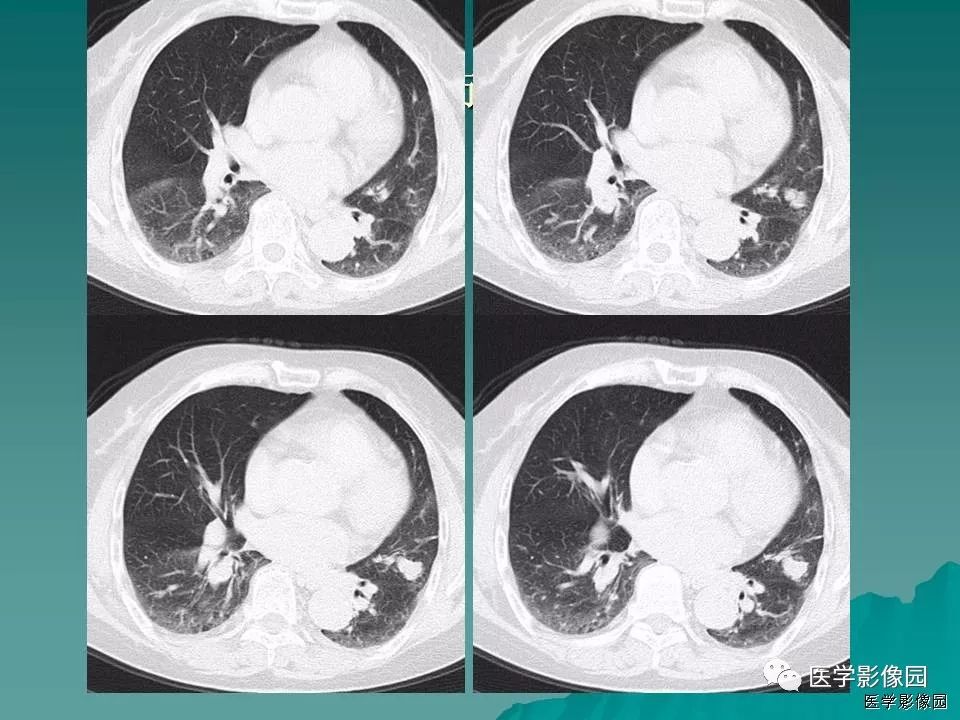 【病例】肺软骨性错构瘤1例CT 【病例】肺软骨性错构瘤1例CT