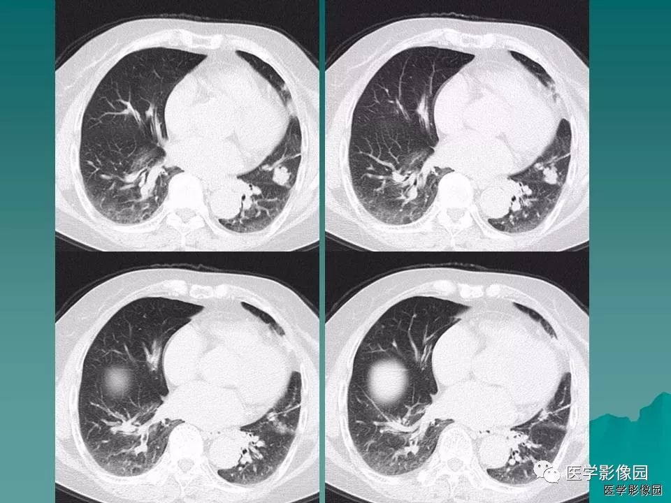 【病例】肺软骨性错构瘤1例CT 【病例】肺软骨性错构瘤1例CT