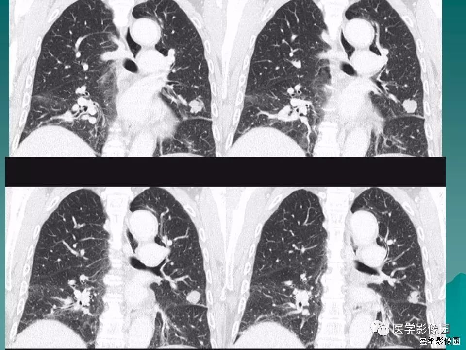 【病例】肺软骨性错构瘤1例CT 【病例】肺软骨性错构瘤1例CT