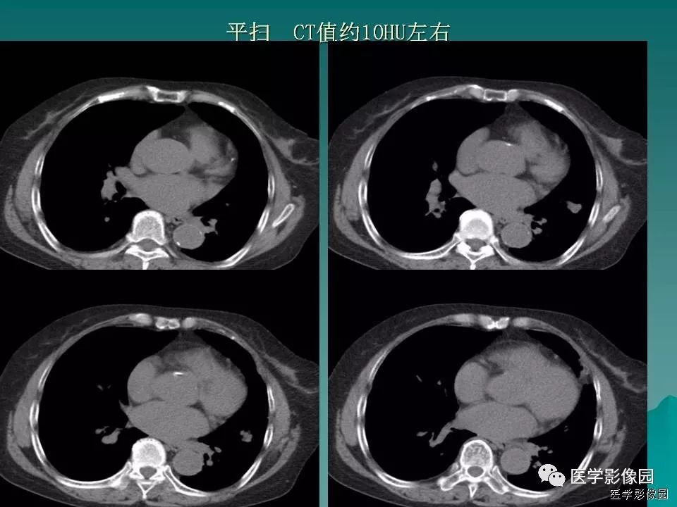 【病例】肺软骨性错构瘤1例CT 【病例】肺软骨性错构瘤1例CT