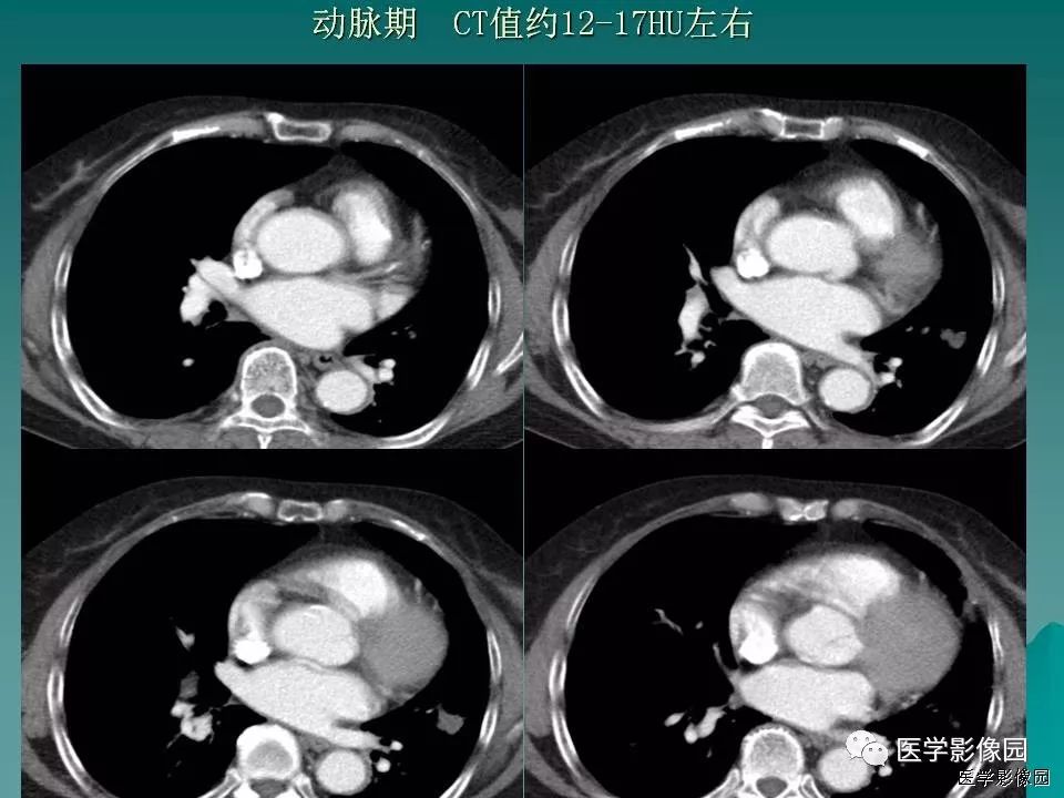 【病例】肺软骨性错构瘤1例CT 【病例】肺软骨性错构瘤1例CT