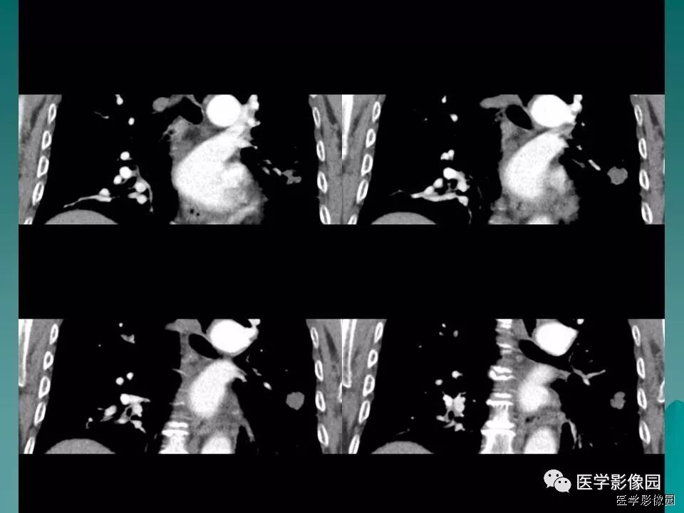 【病例】肺软骨性错构瘤1例CT 【病例】肺软骨性错构瘤1例CT