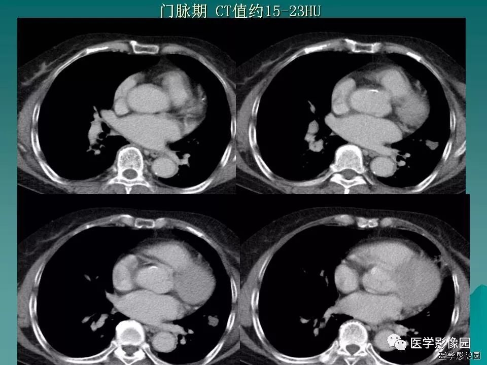 【病例】肺软骨性错构瘤1例CT 【病例】肺软骨性错构瘤1例CT
