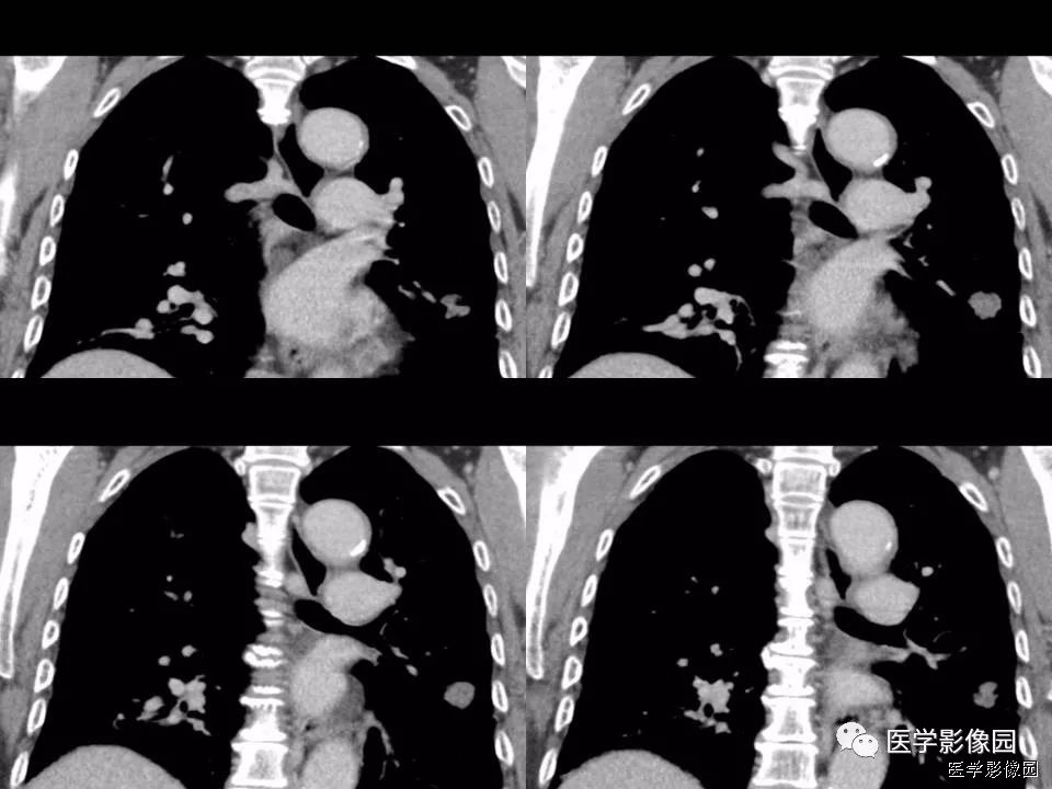 【病例】肺软骨性错构瘤1例CT 【病例】肺软骨性错构瘤1例CT