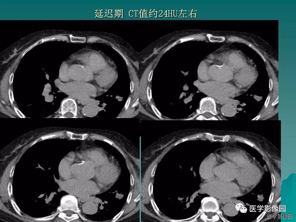 【病例】肺软骨性错构瘤1例CT 【病例】肺软骨性错构瘤1例CT