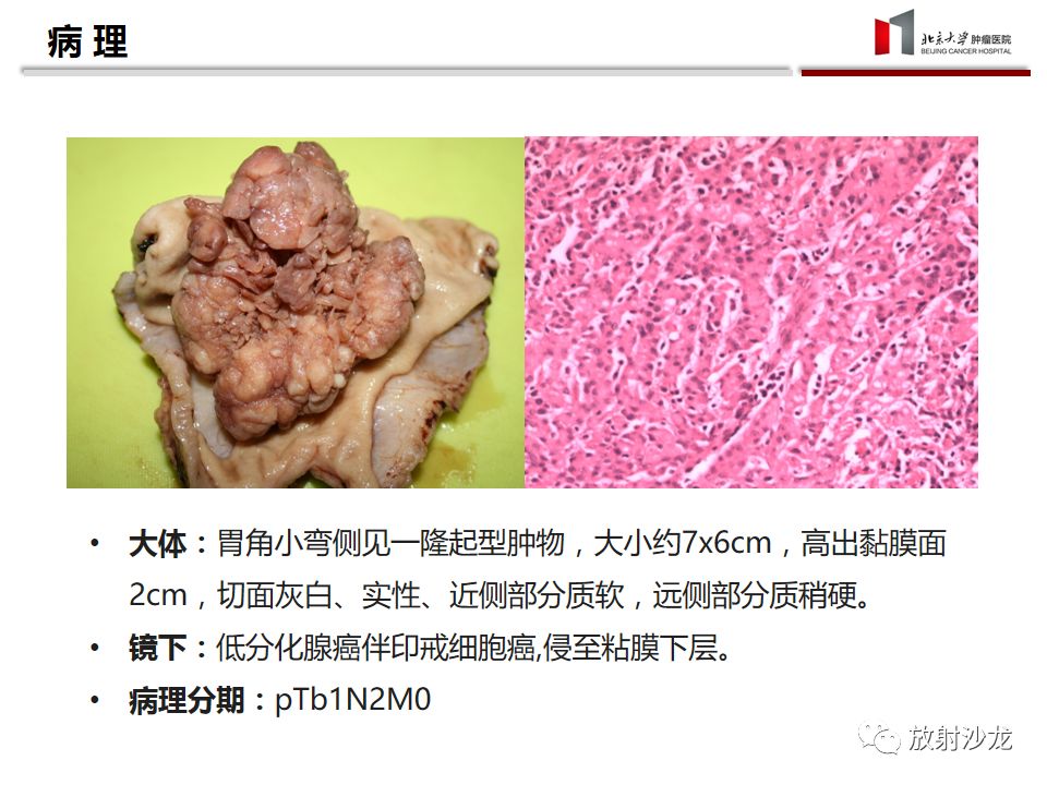 【病例】胃癌1例CT影像诊断思路分析