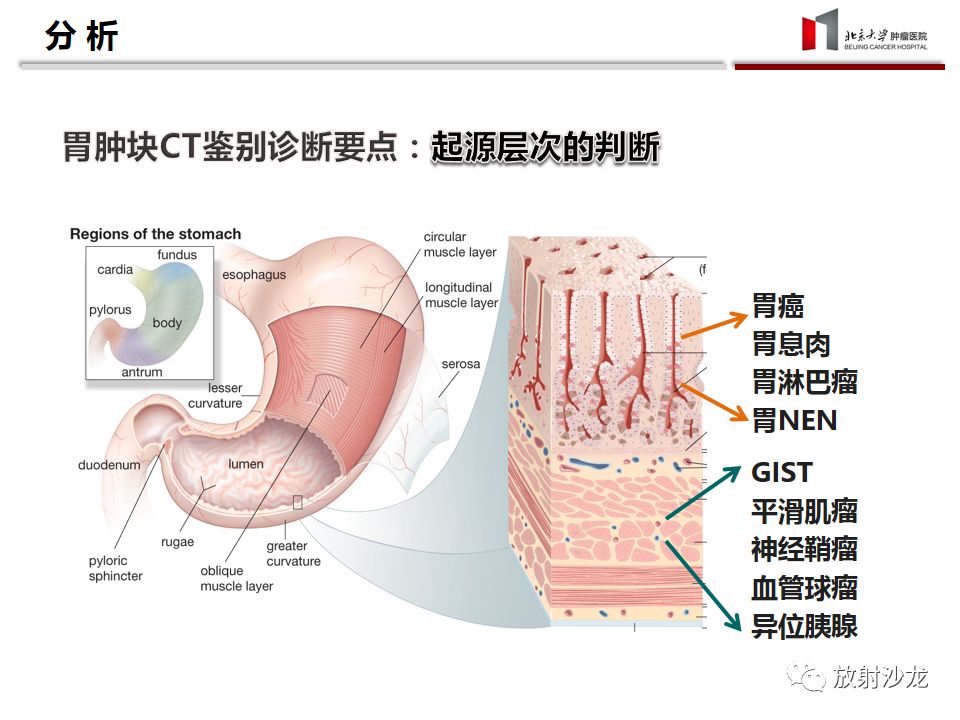 【病例】胃癌1例CT影像诊断思路分析
