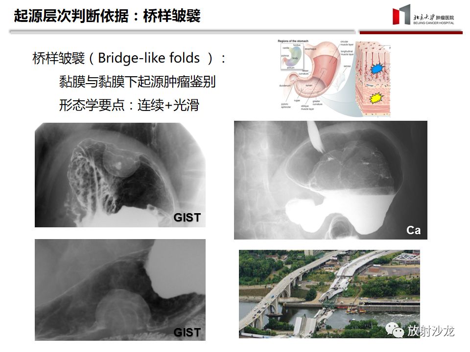 【病例】胃癌1例CT影像诊断思路分析