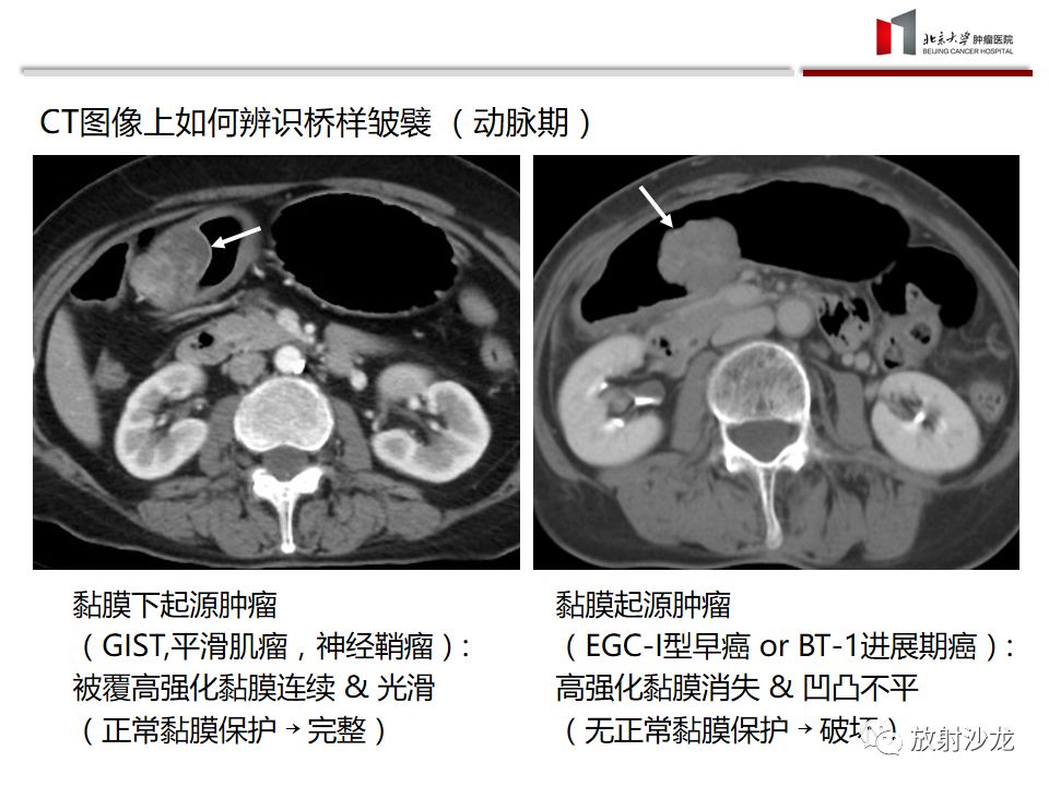 【病例】胃癌1例CT影像诊断思路分析