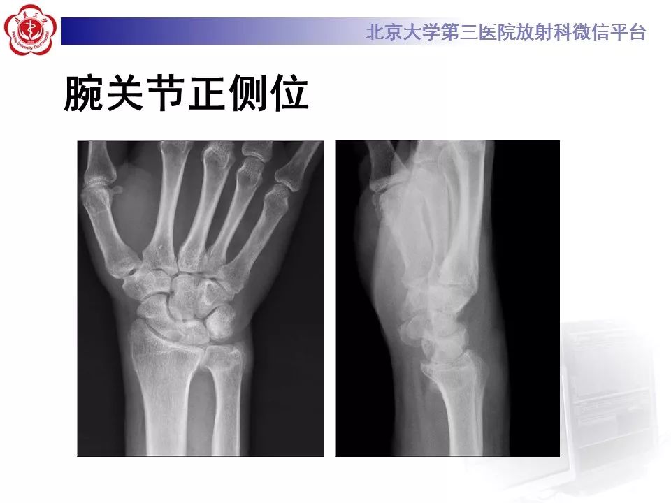【病例】尺骨撞击综合征1例X线及MR影像表现