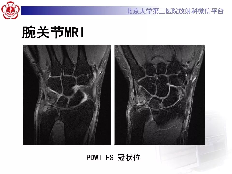【病例】尺骨撞击综合征1例X线及MR影像表现