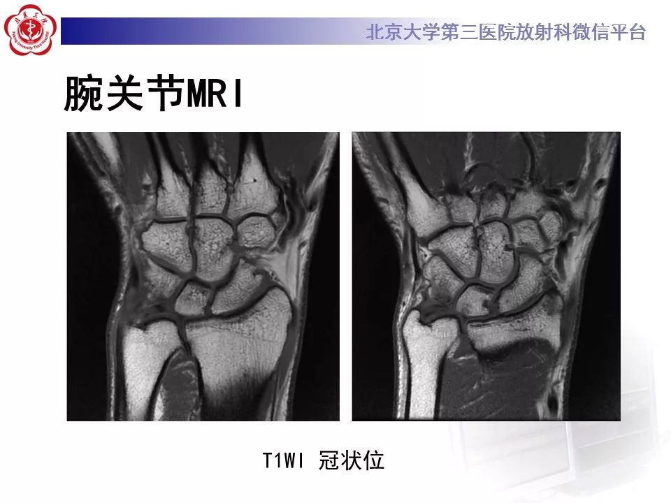 【病例】尺骨撞击综合征1例X线及MR影像表现