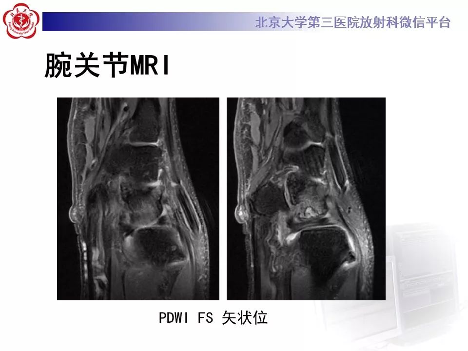 【病例】尺骨撞击综合征1例X线及MR影像表现