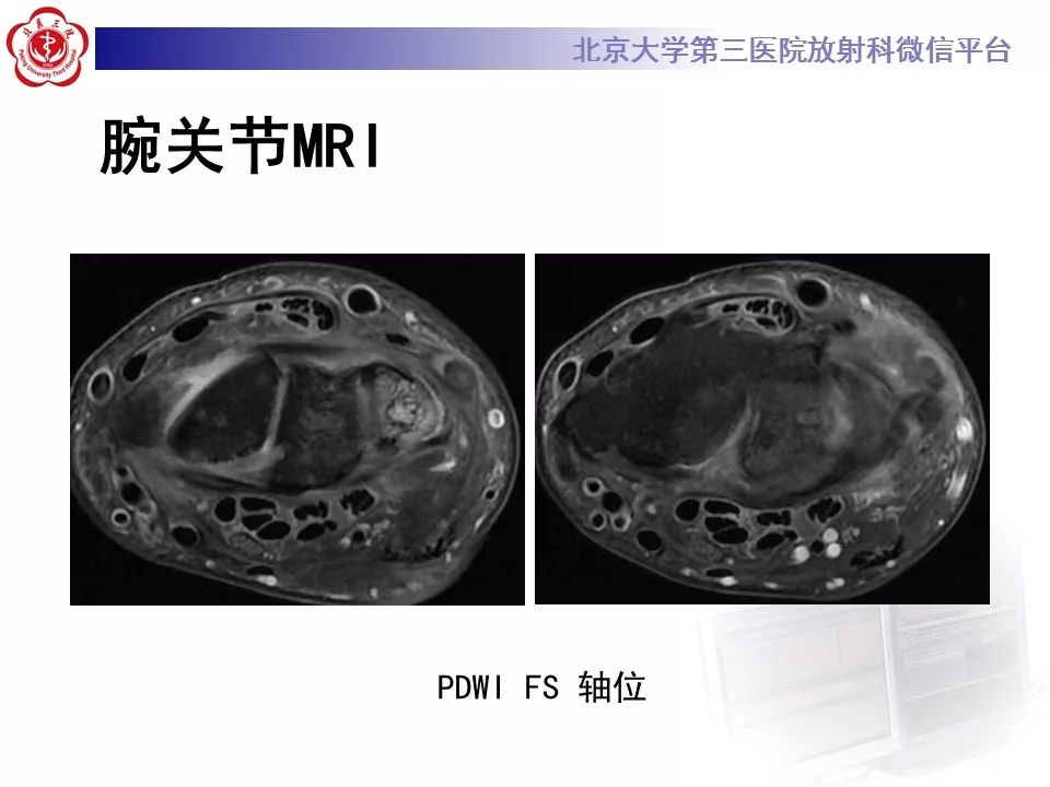 【病例】尺骨撞击综合征1例X线及MR影像表现