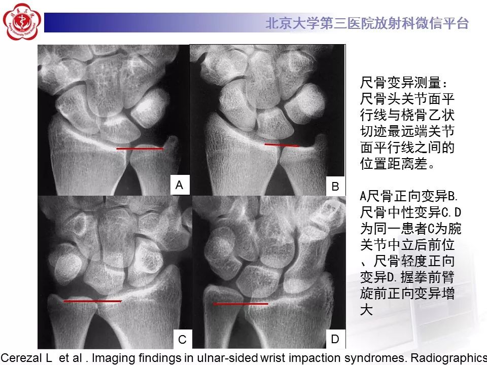 【病例】尺骨撞击综合征1例X线及MR影像表现