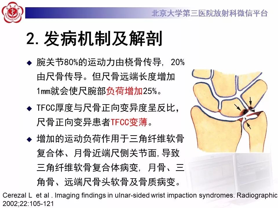 【病例】尺骨撞击综合征1例X线及MR影像表现