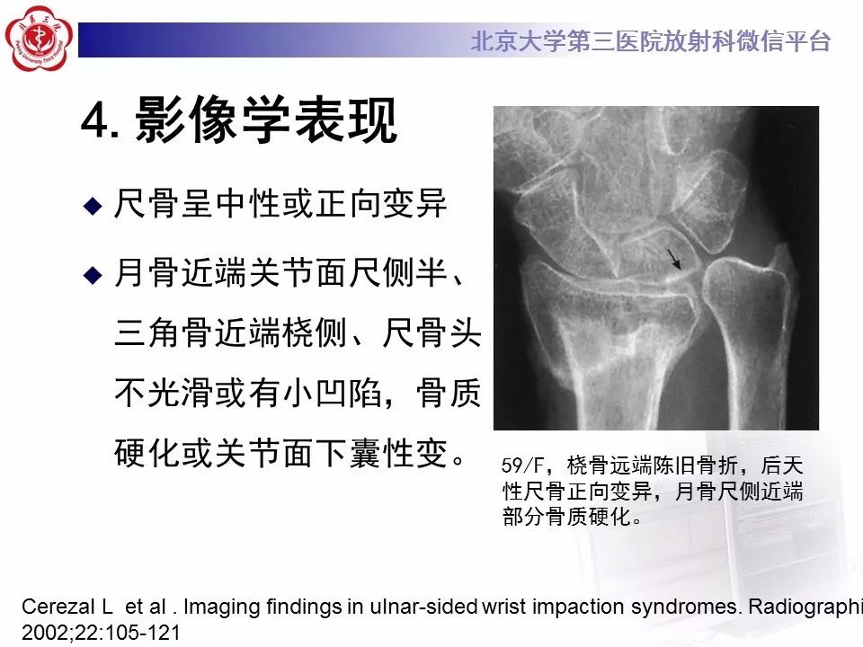 【病例】尺骨撞击综合征1例X线及MR影像表现