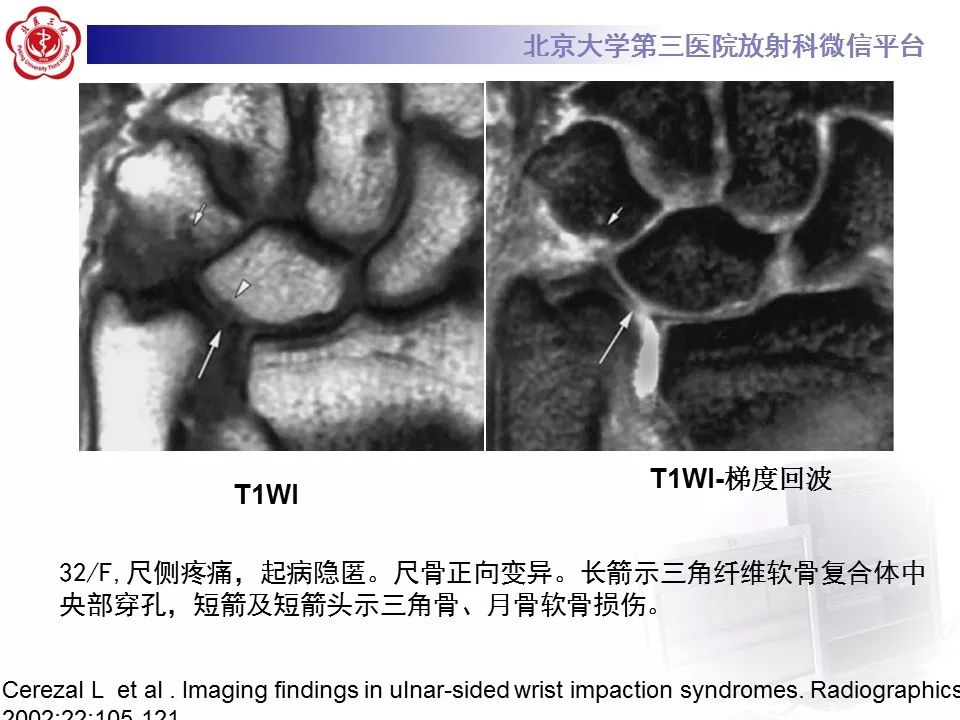 【病例】尺骨撞击综合征1例X线及MR影像表现