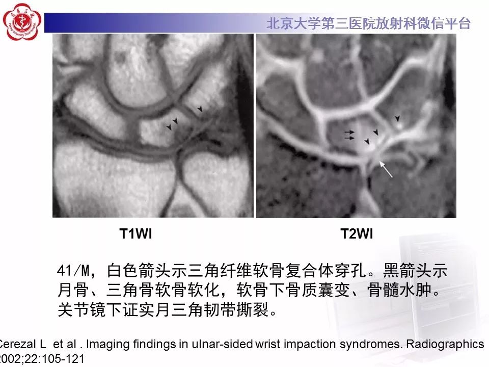 【病例】尺骨撞击综合征1例X线及MR影像表现