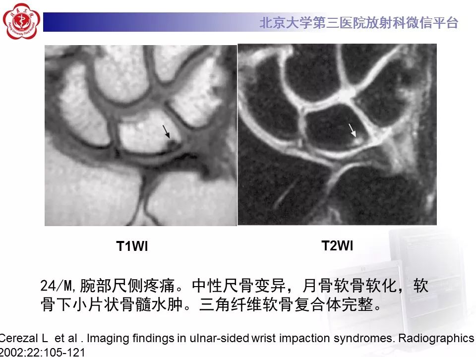 【病例】尺骨撞击综合征1例X线及MR影像表现