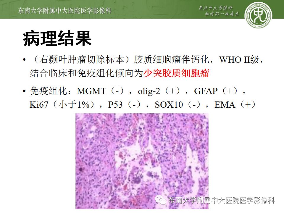 【病例】少突胶质细胞瘤1例MR影像诊断分析