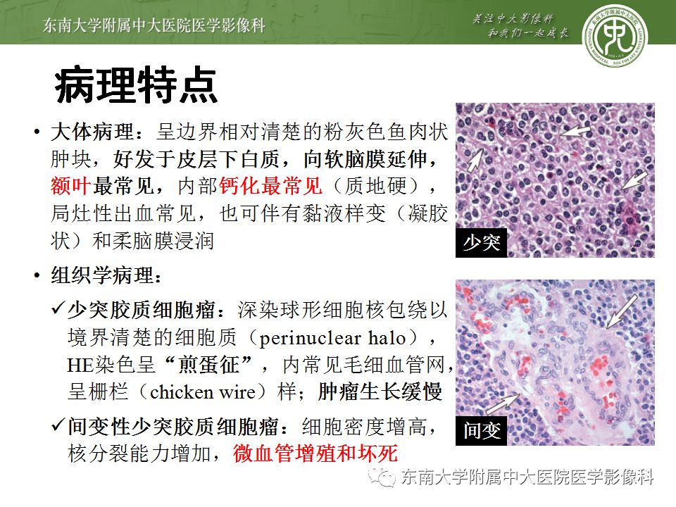 【病例】少突胶质细胞瘤1例MR影像诊断分析