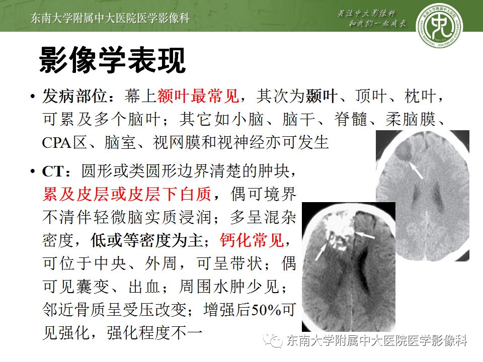 【病例】少突胶质细胞瘤1例MR影像诊断分析