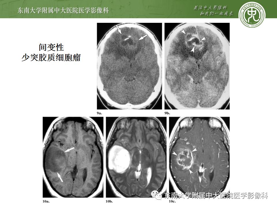 【病例】少突胶质细胞瘤1例MR影像诊断分析